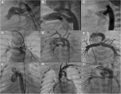 Stenting of high-tortuous ducts in duct-dependent pulmonary circulation: essential points to consider before deciding on stenting